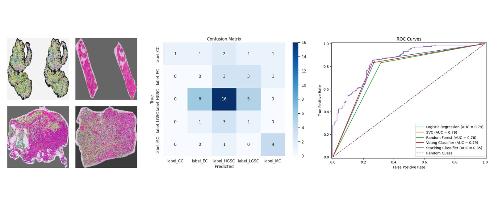 Outputs from the notebooks: ovarian cancer tissue images, a confusion matrix of the CNN classifier, and ROC curves comparing classifiers